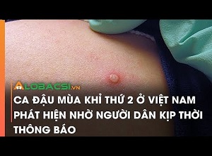 Ca đậu mùa khỉ thứ 2 ở Việt Nam phát hiện nhờ người dân kịp thời thông báo